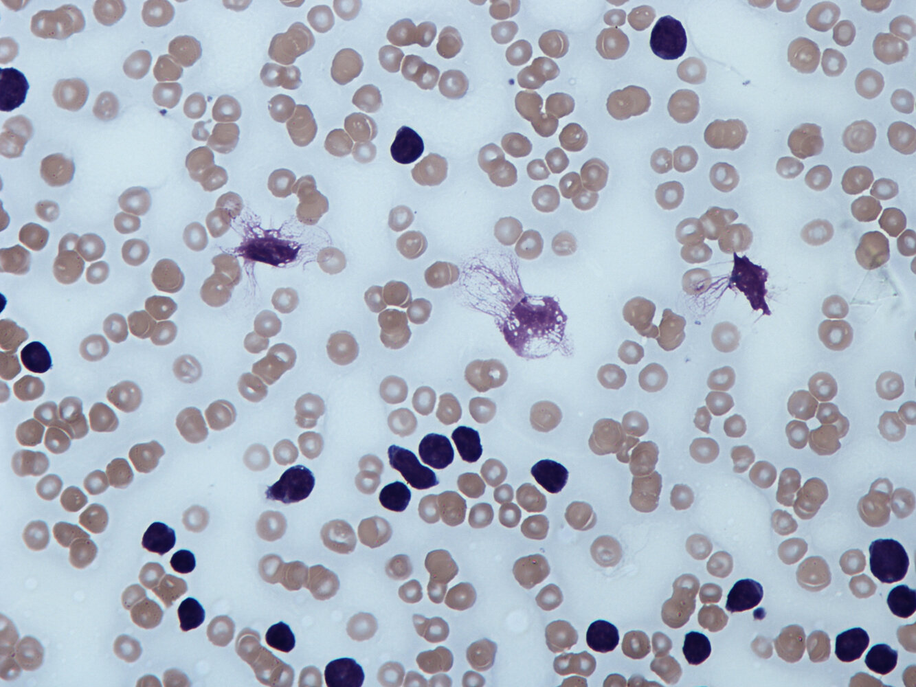 Smudge cells in chronic lymphocytic leukemia (CLL)