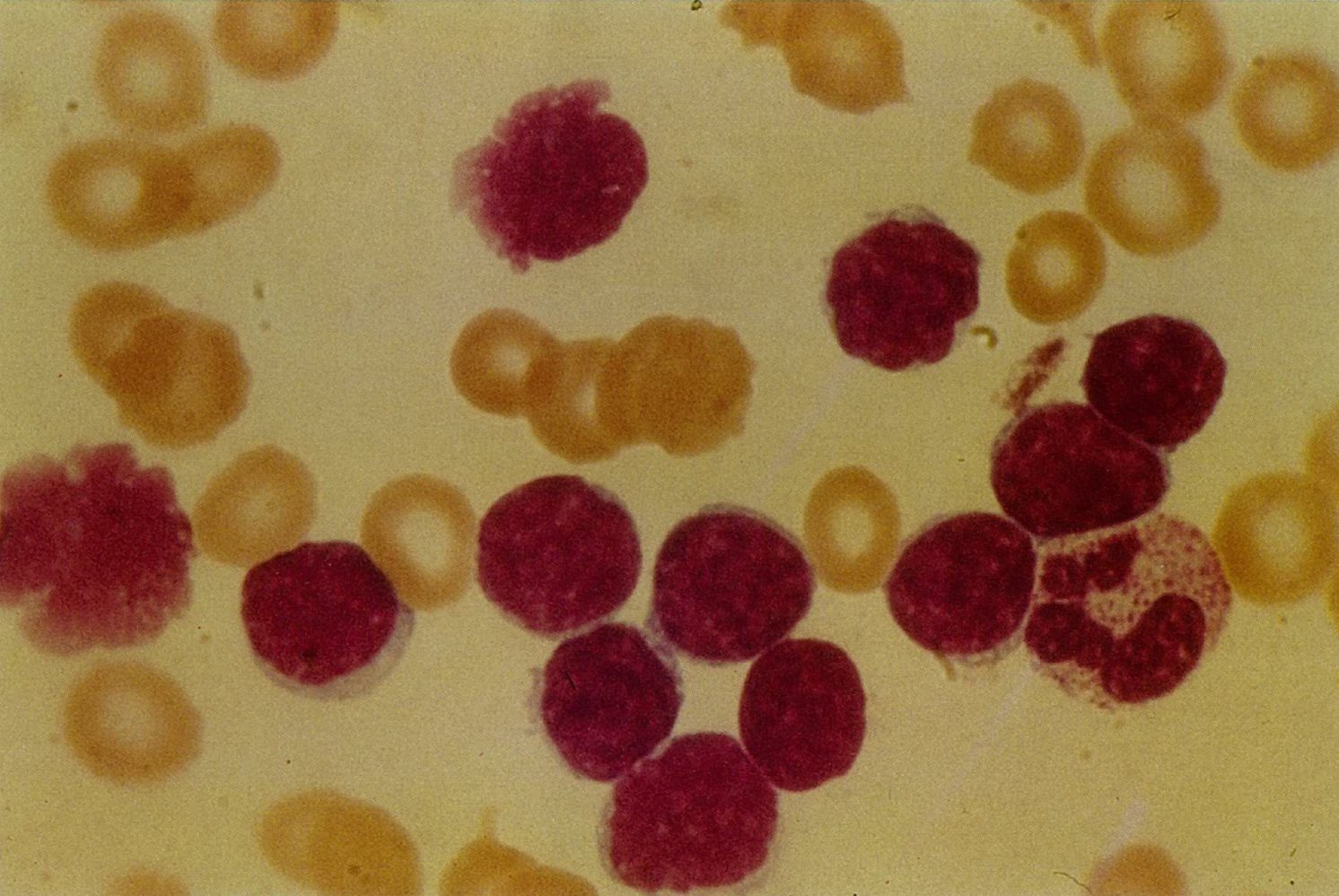 Smudge cells in chronic lymphocytic leukemia (CLL)