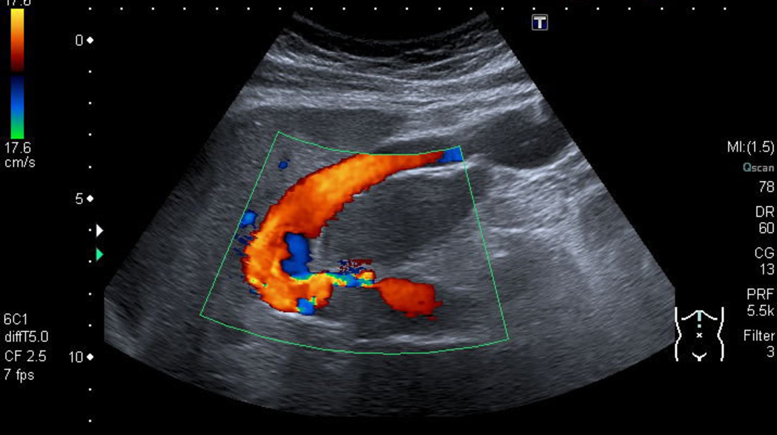 Recanalized paraumbilical vein