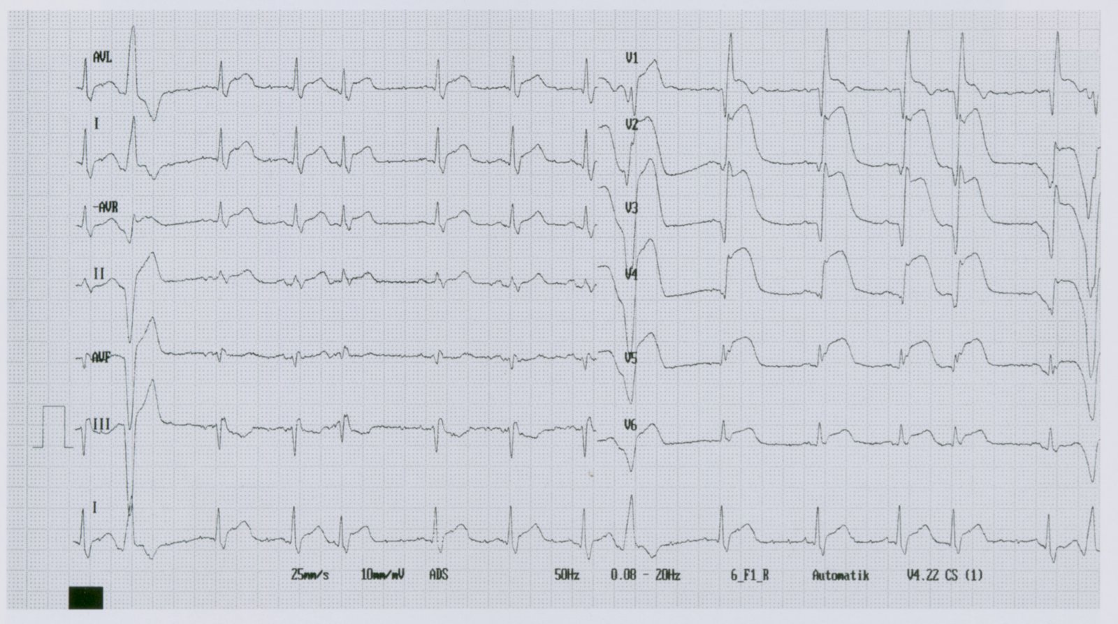 Acute anterior ST-elevation myocardial infarction (STEMI)
