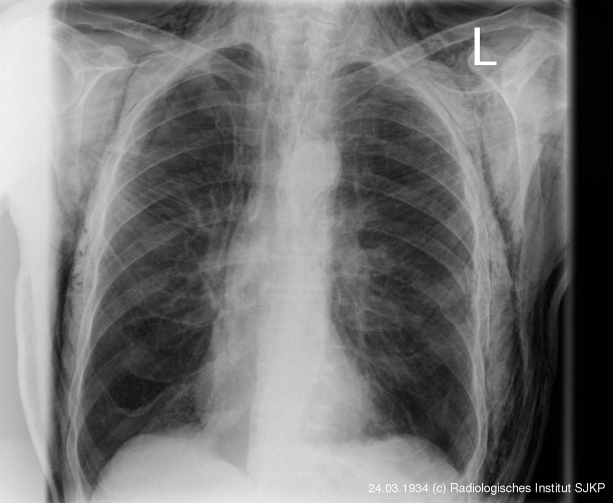 Subcutaneous and mediastinal emphysema