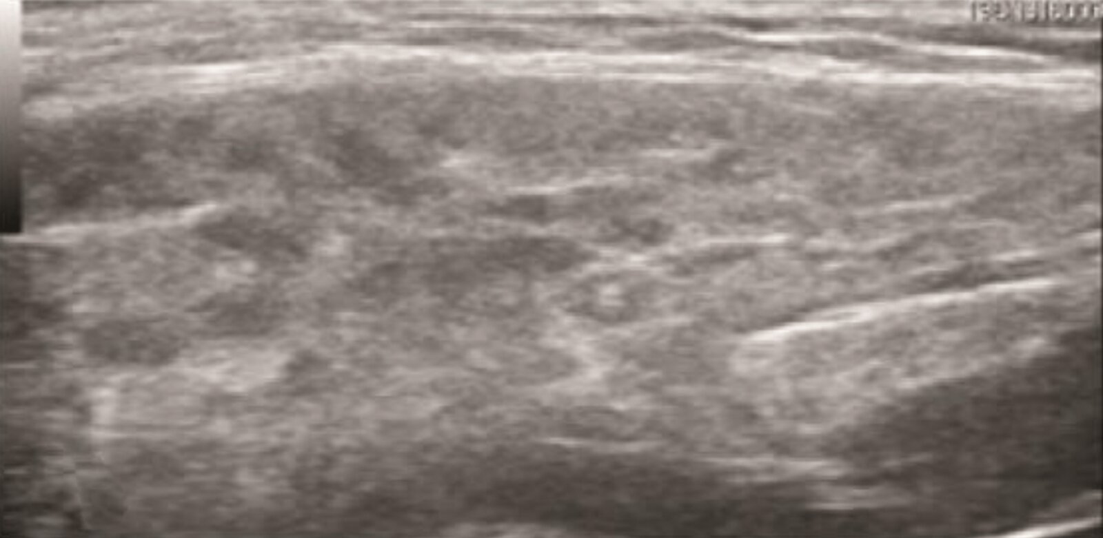 Sjogren syndrome of the parotid gland