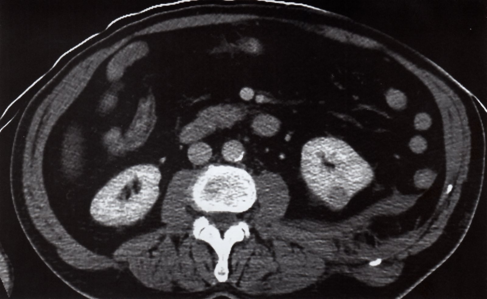 Left retroperitoneal hemorrhage