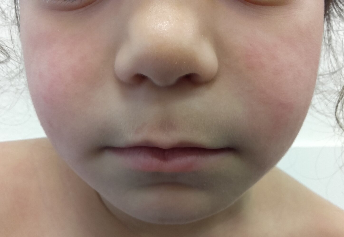 Slapped‑cheek rash