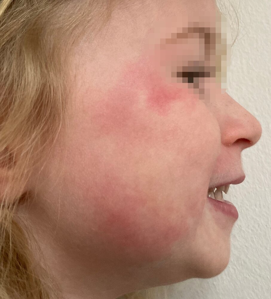 Slapped‑cheek rash