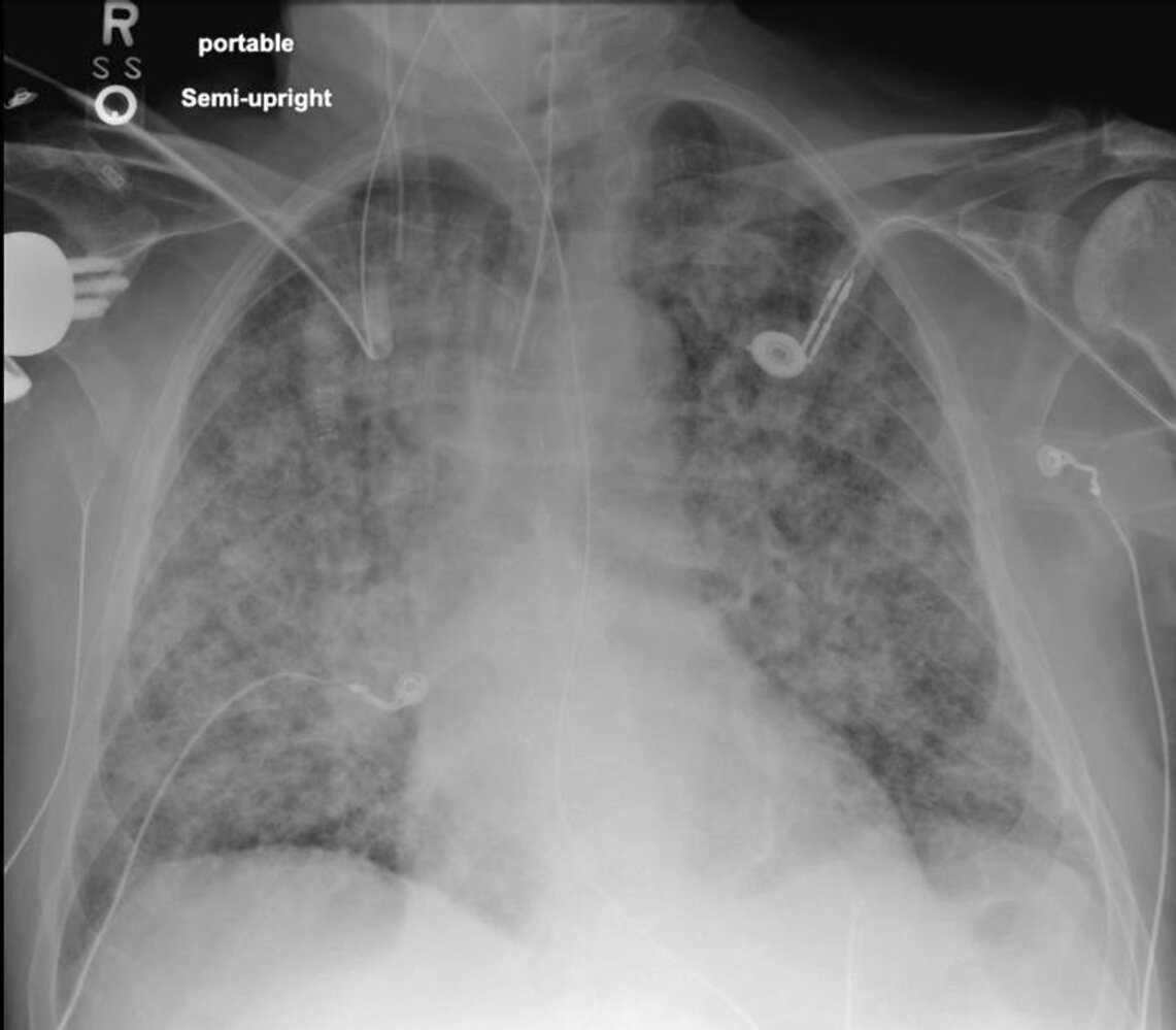 Noncardiogenic edema