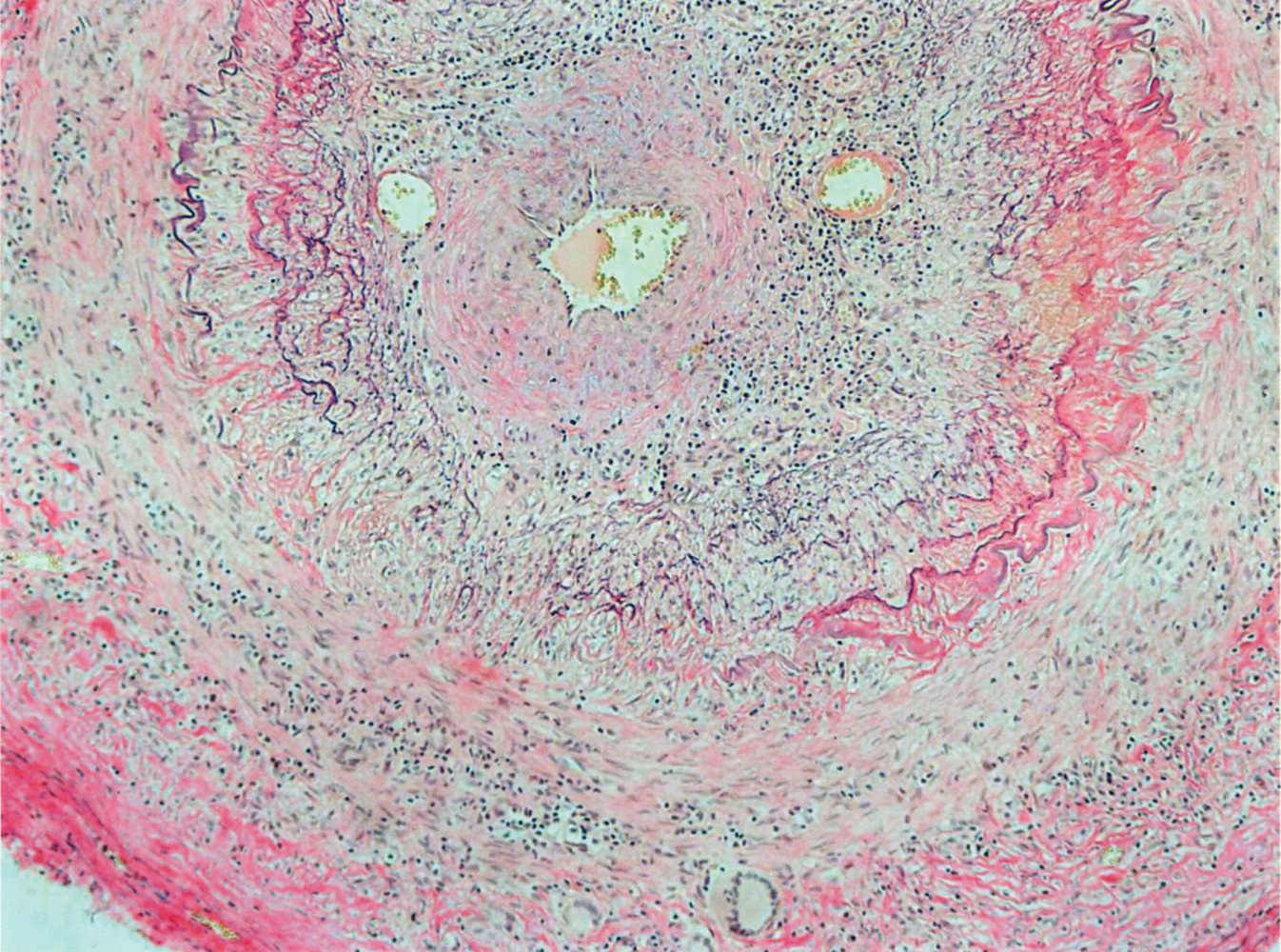 Temporal arteritis