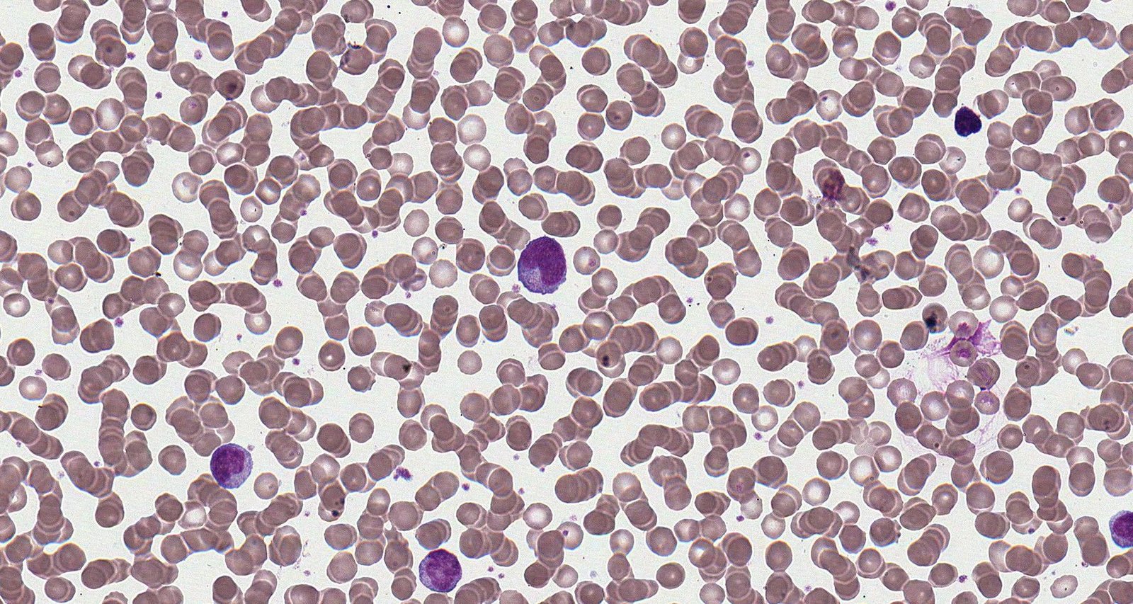 Infectious mononucleosis (peripheral blood smear)
