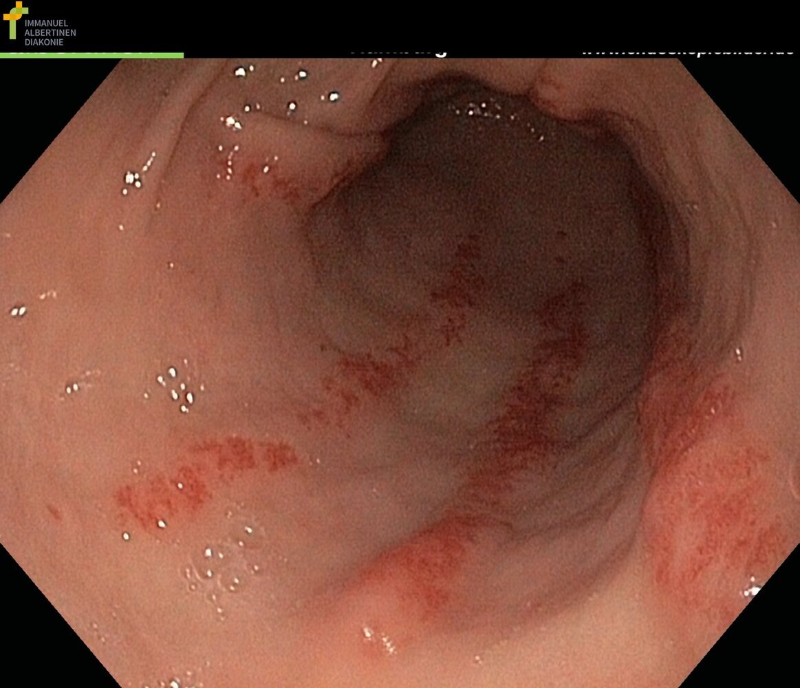 Gastric antral vascular ectasia
