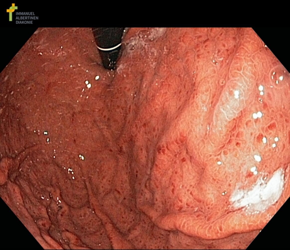 Portal hypertensive gastropathy