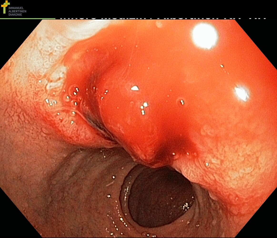 Gastric ulcer: Forrest stage Ib