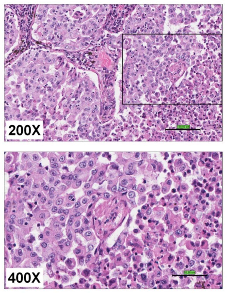 Large cell carcinoma of the lung