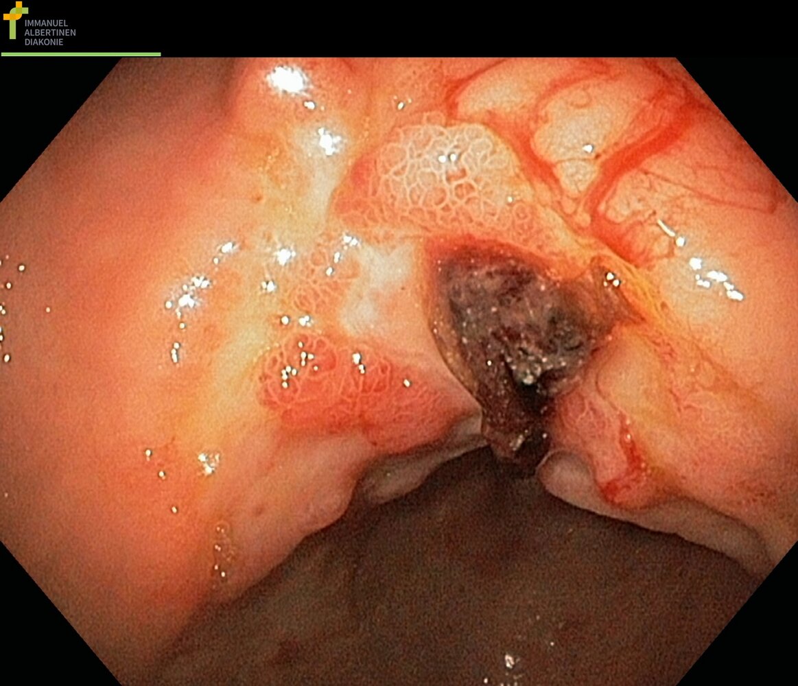 Gastric ulcer: Forrest stage IIb