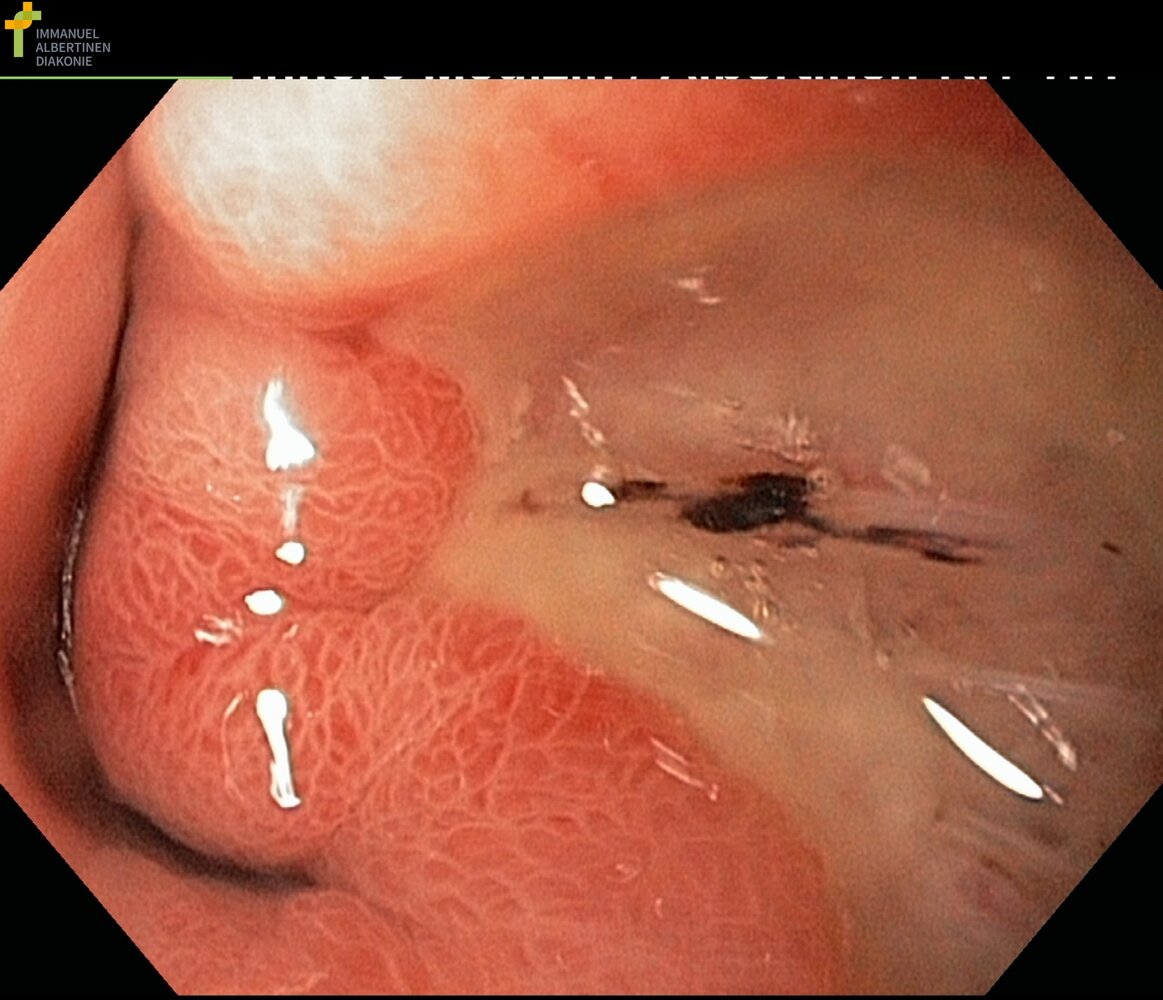 Duodenal ulcer: Forrest stage IIc