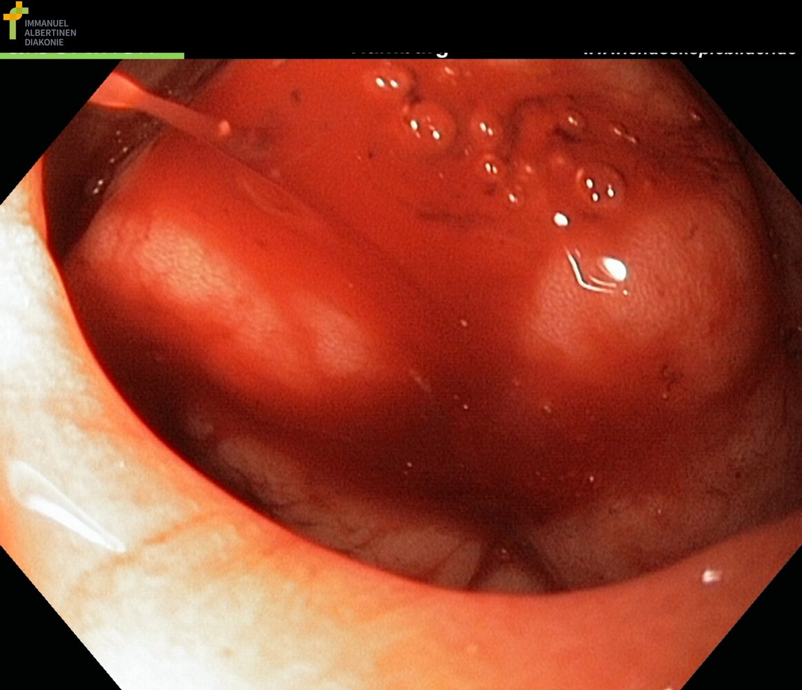 Duodenal ulcer: Forrest stage Ib