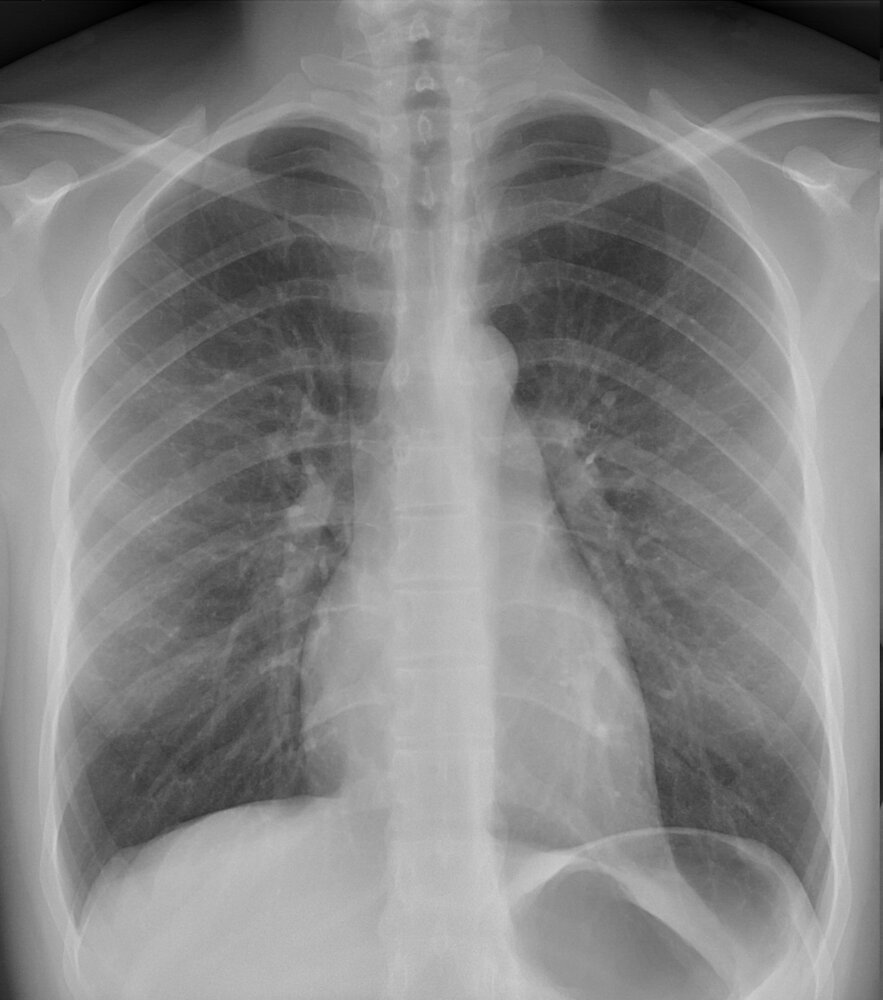 Normal chest radiograph