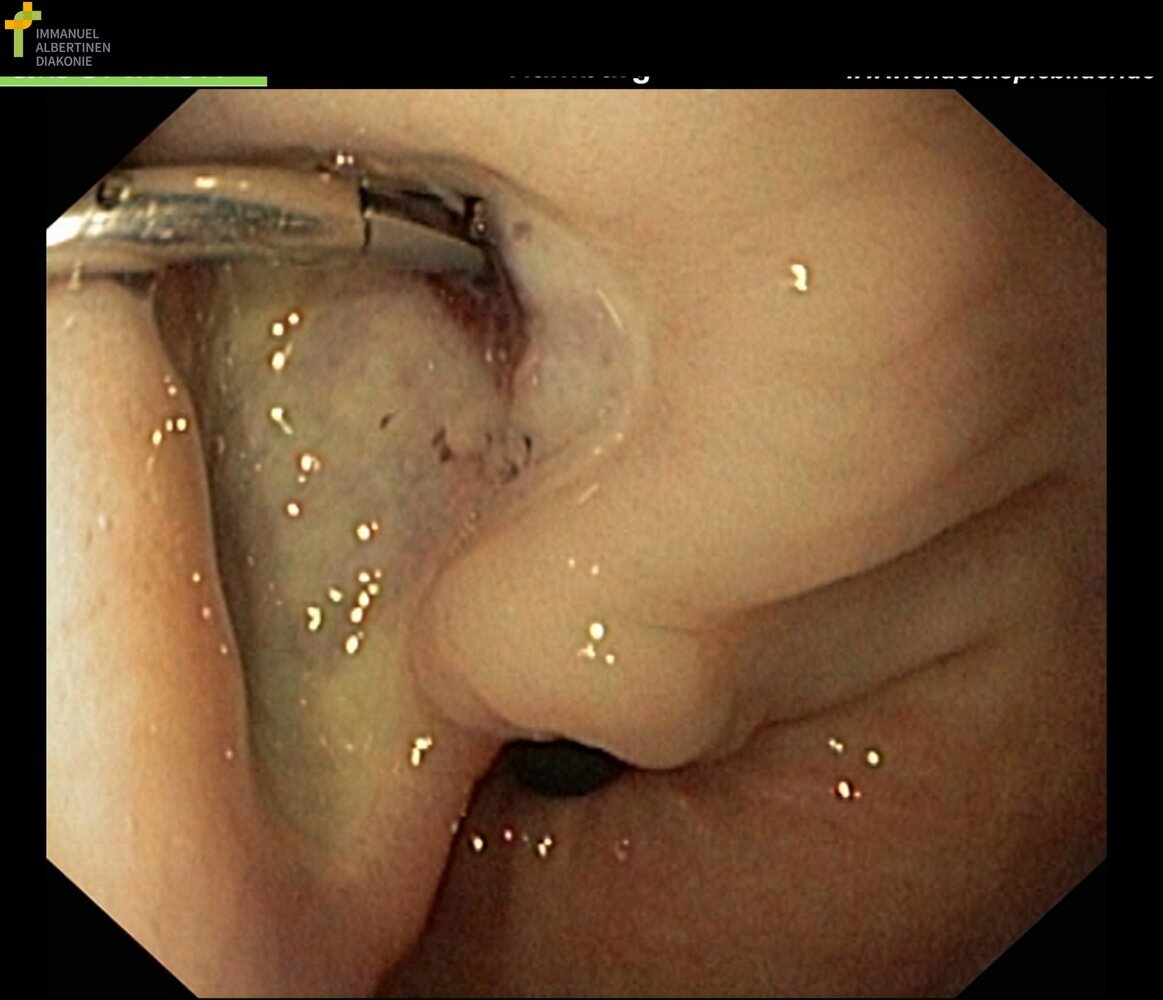 Endoscopic hemostasis with clip placement