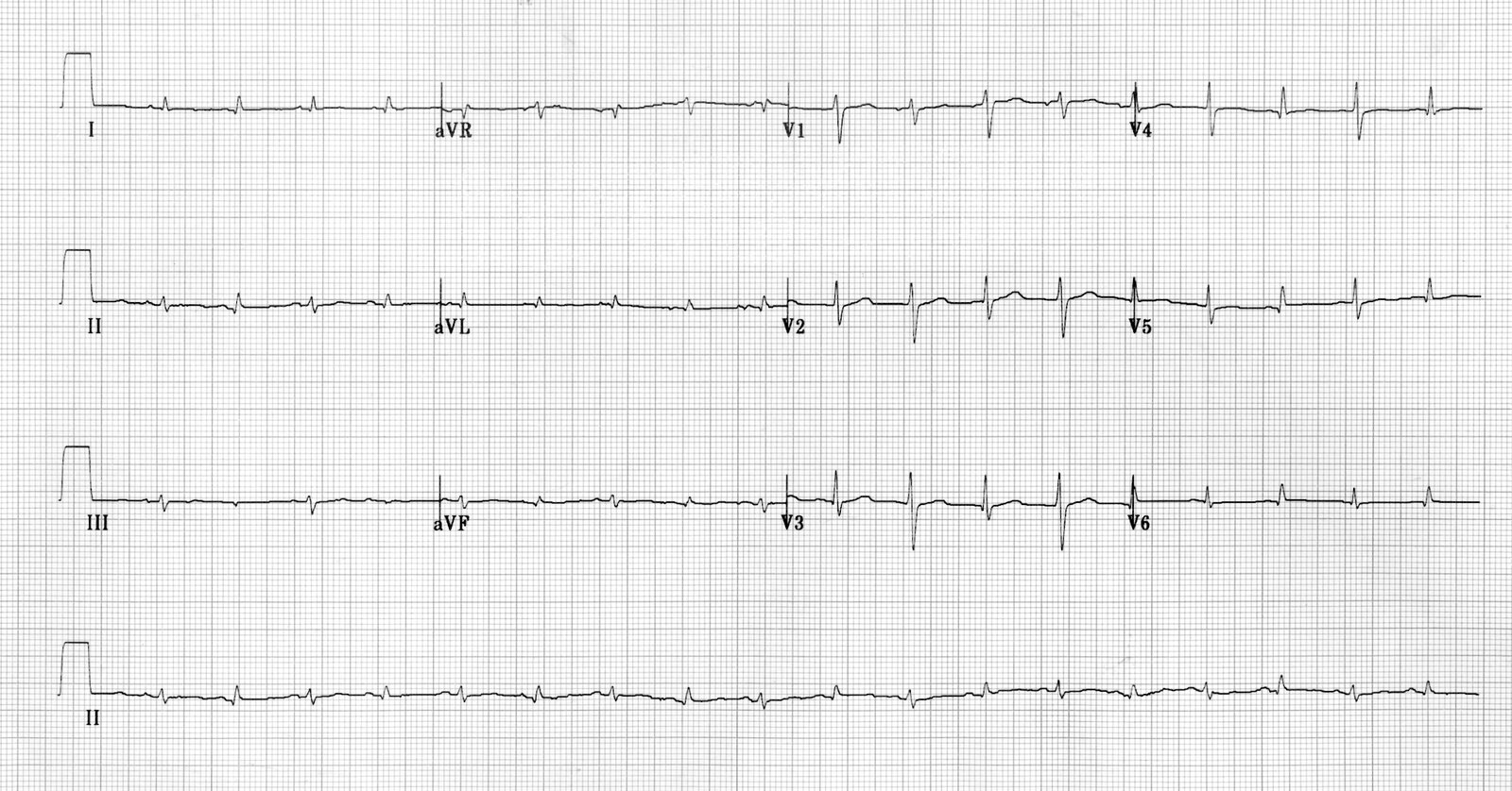 Electrical alternans