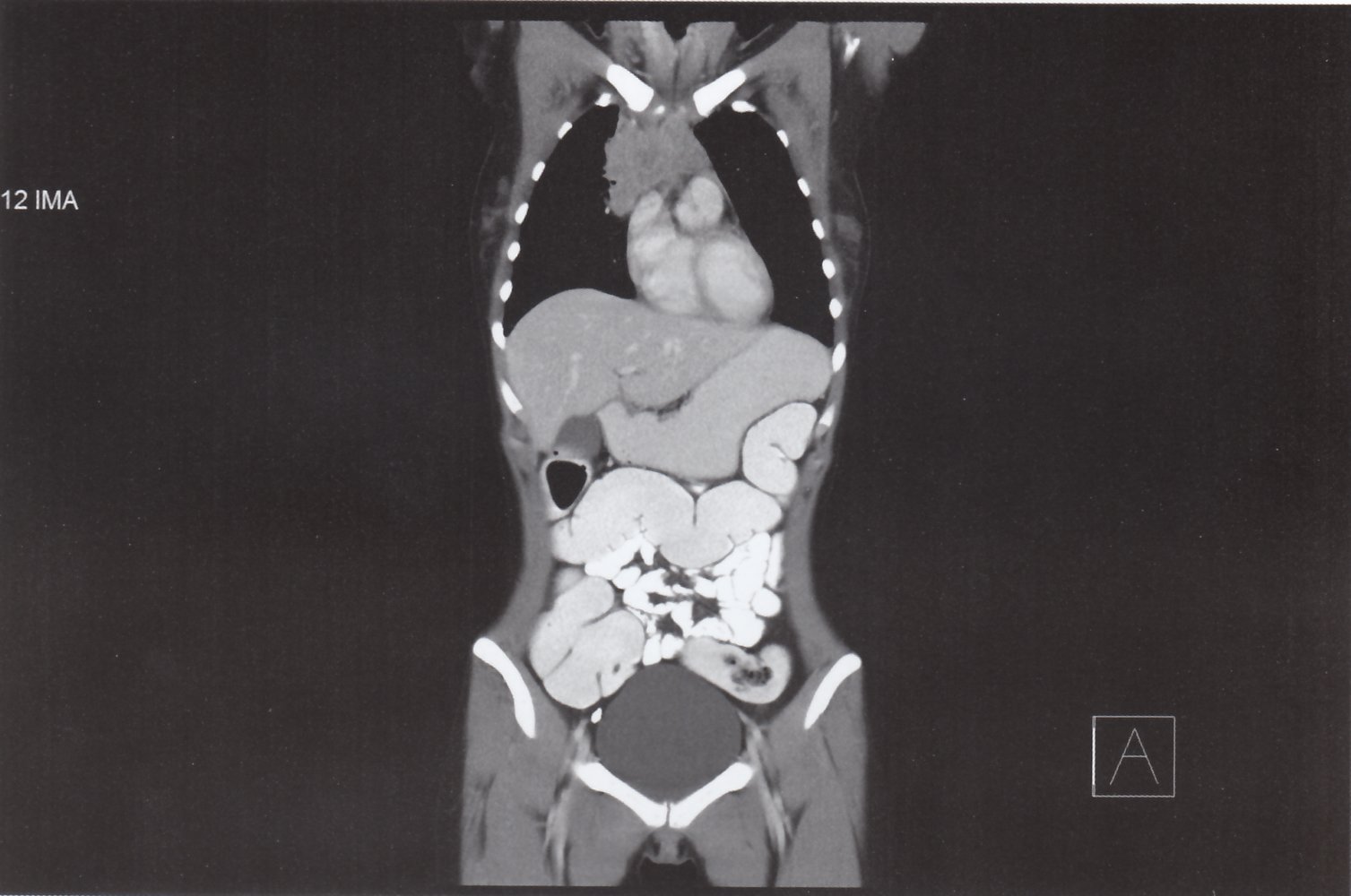 Anterior mediastinal mass in Hodgkin lymphoma 2/2