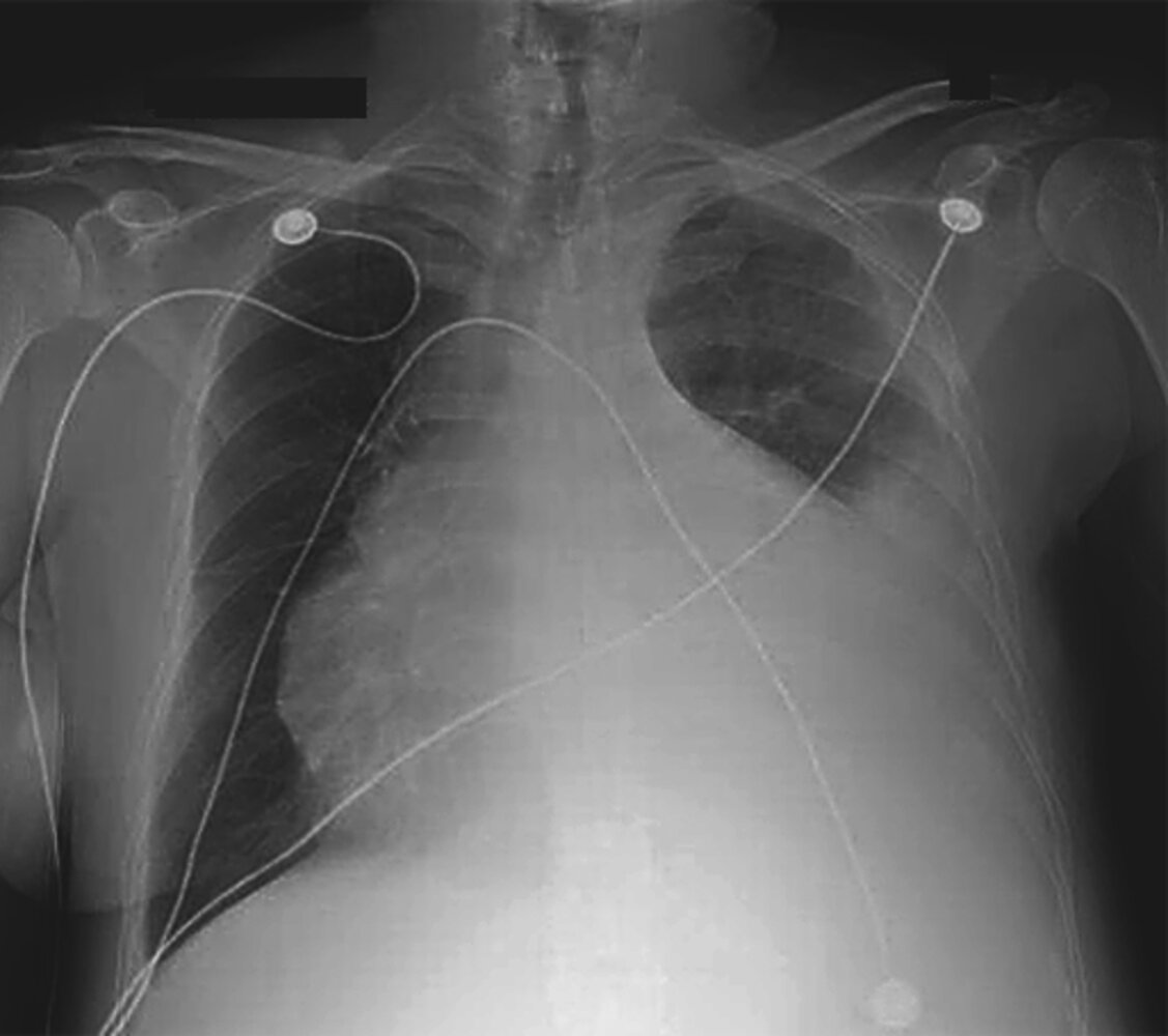 Enlarged cardiac silhouette and left pleural effusion