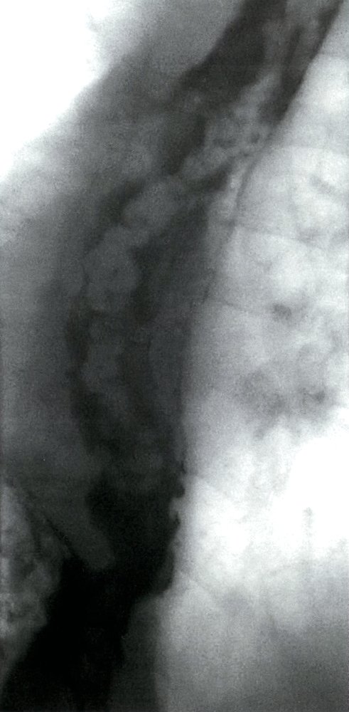 Esophageal varices