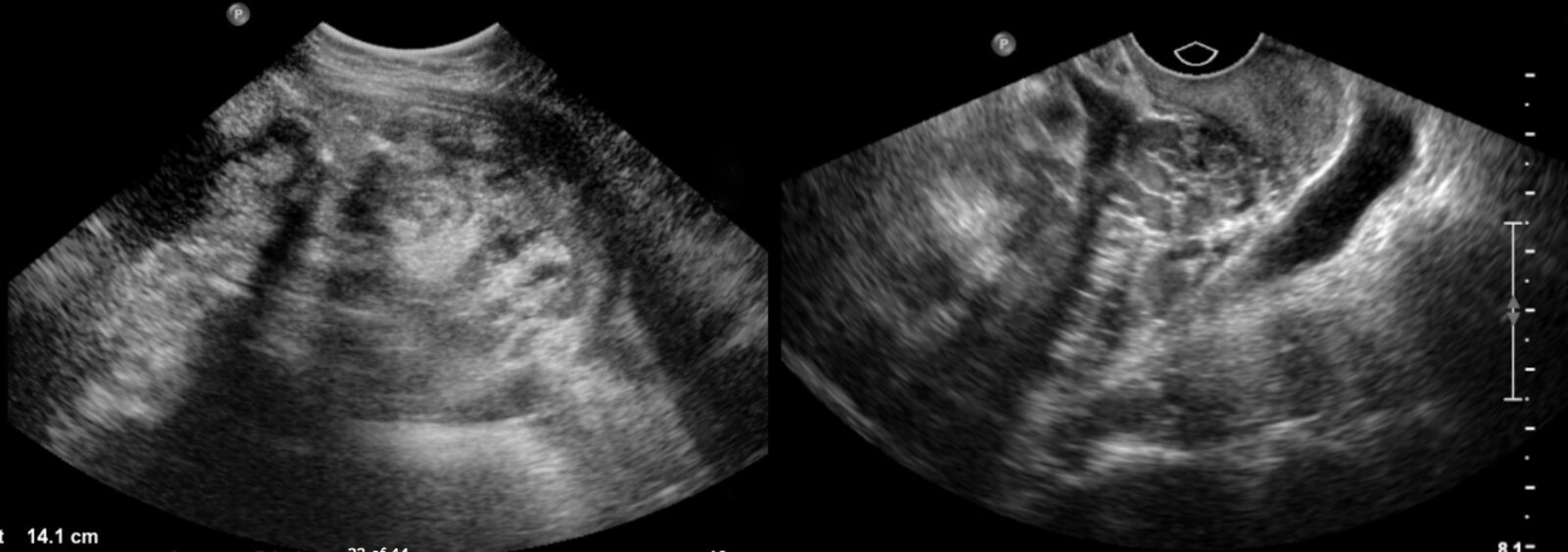 Ovarian Teratoma (1/2)