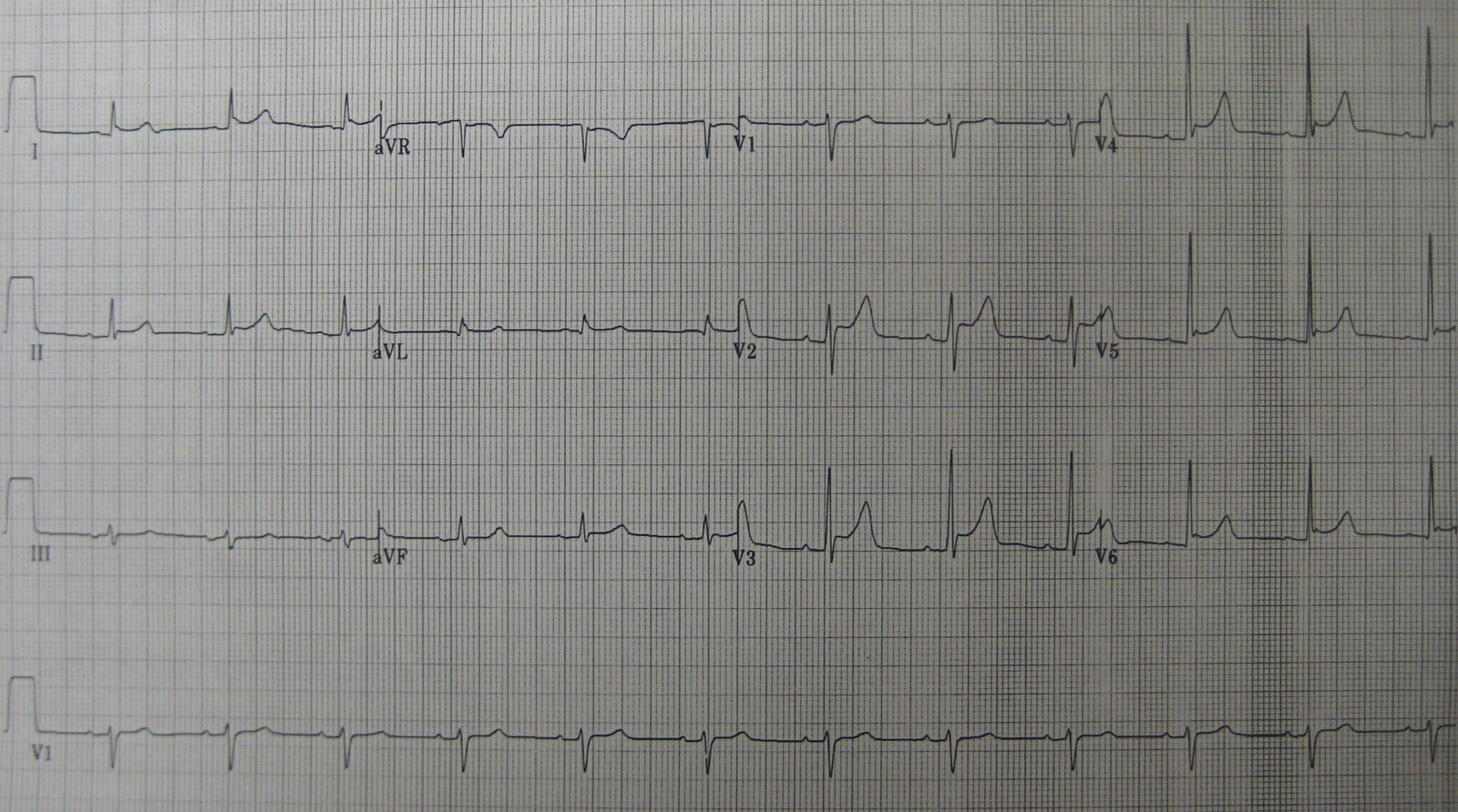 Pericarditis