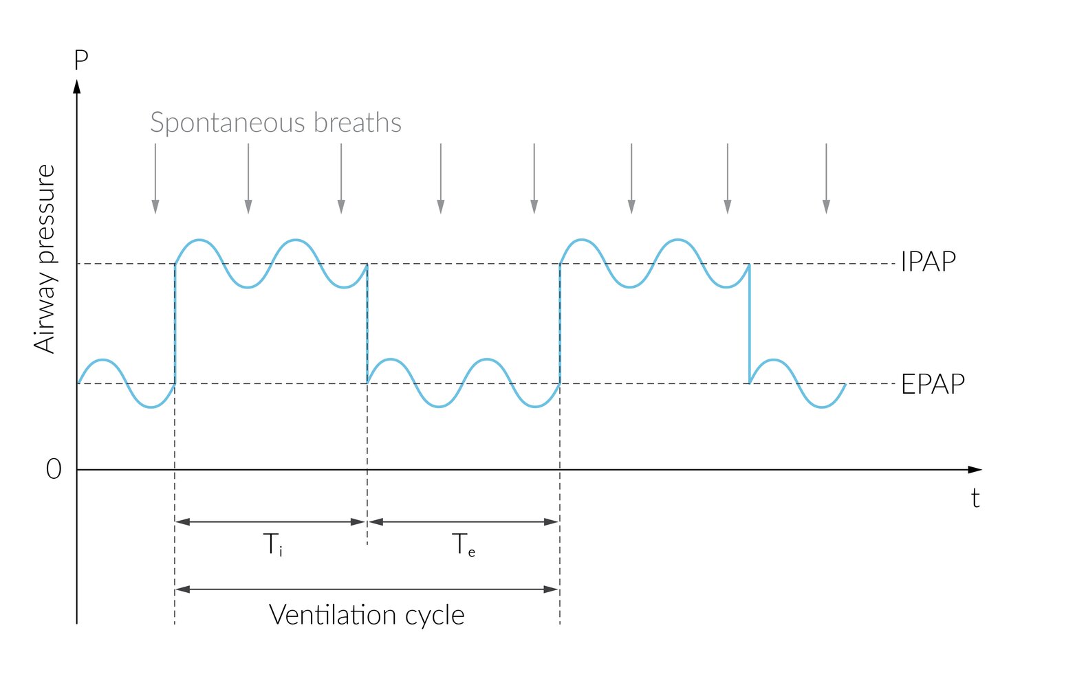 Biphasic Positive Airway Pressure (BIPAP)