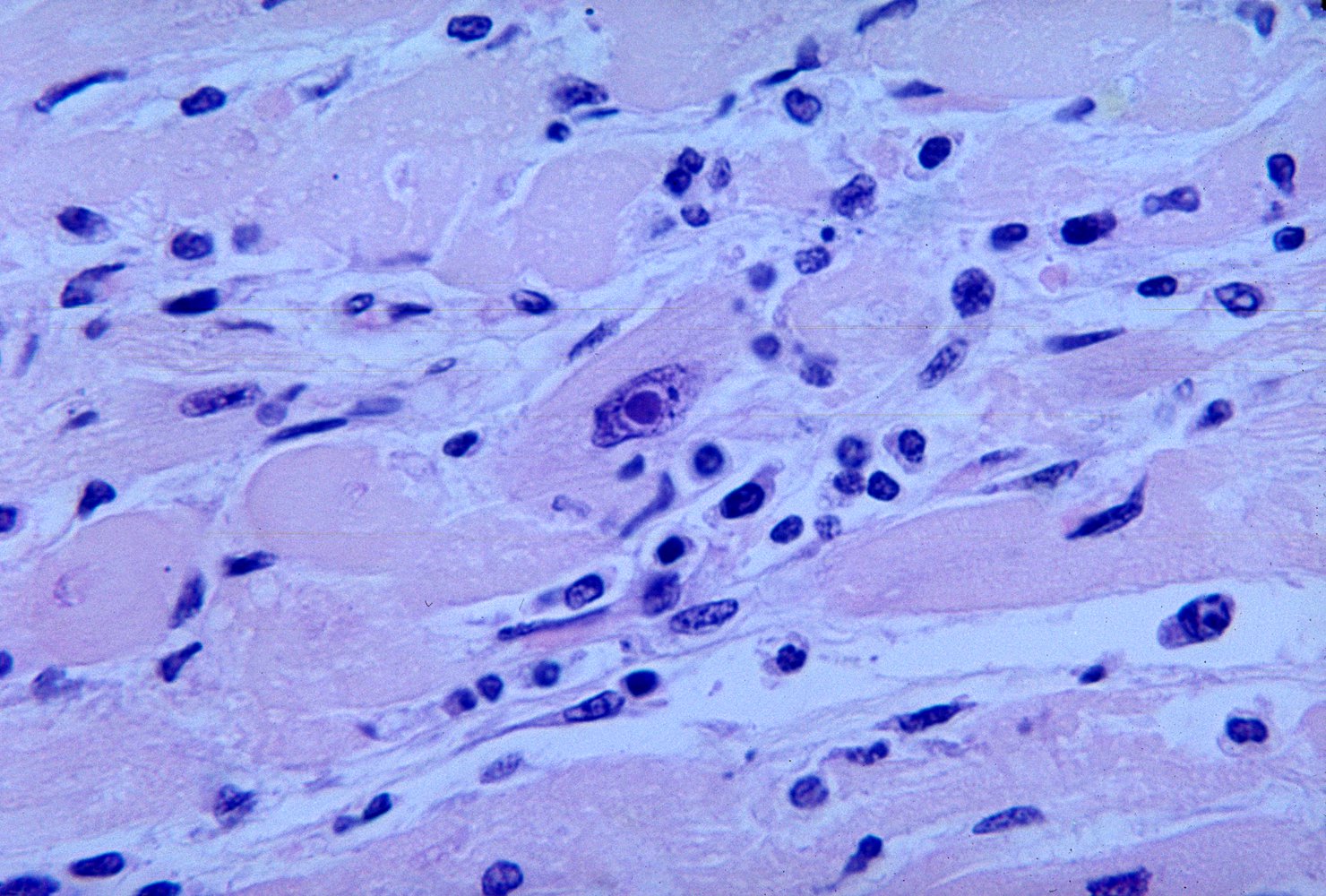 Diphtheritic myocarditis