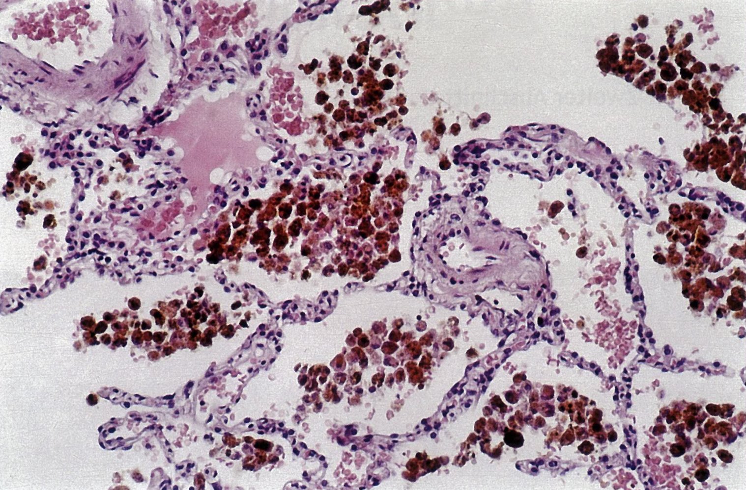 Heart failure cells in decompensated heart failure