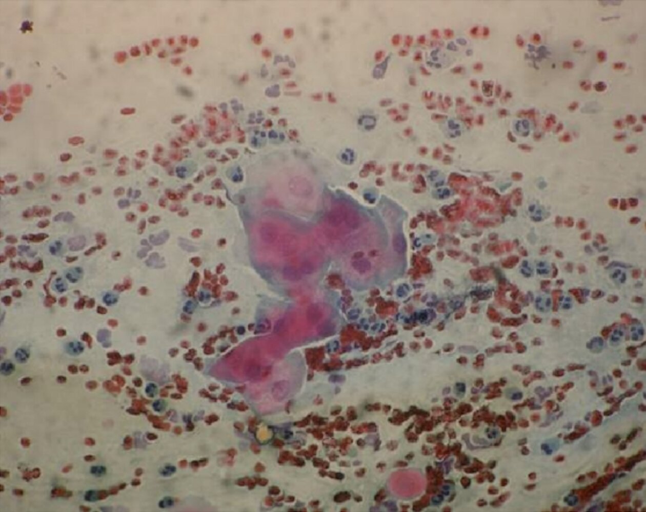 Atypical squamous cells, cannot exclude high-grade squamous intraepithelial lesion (ASC-H)