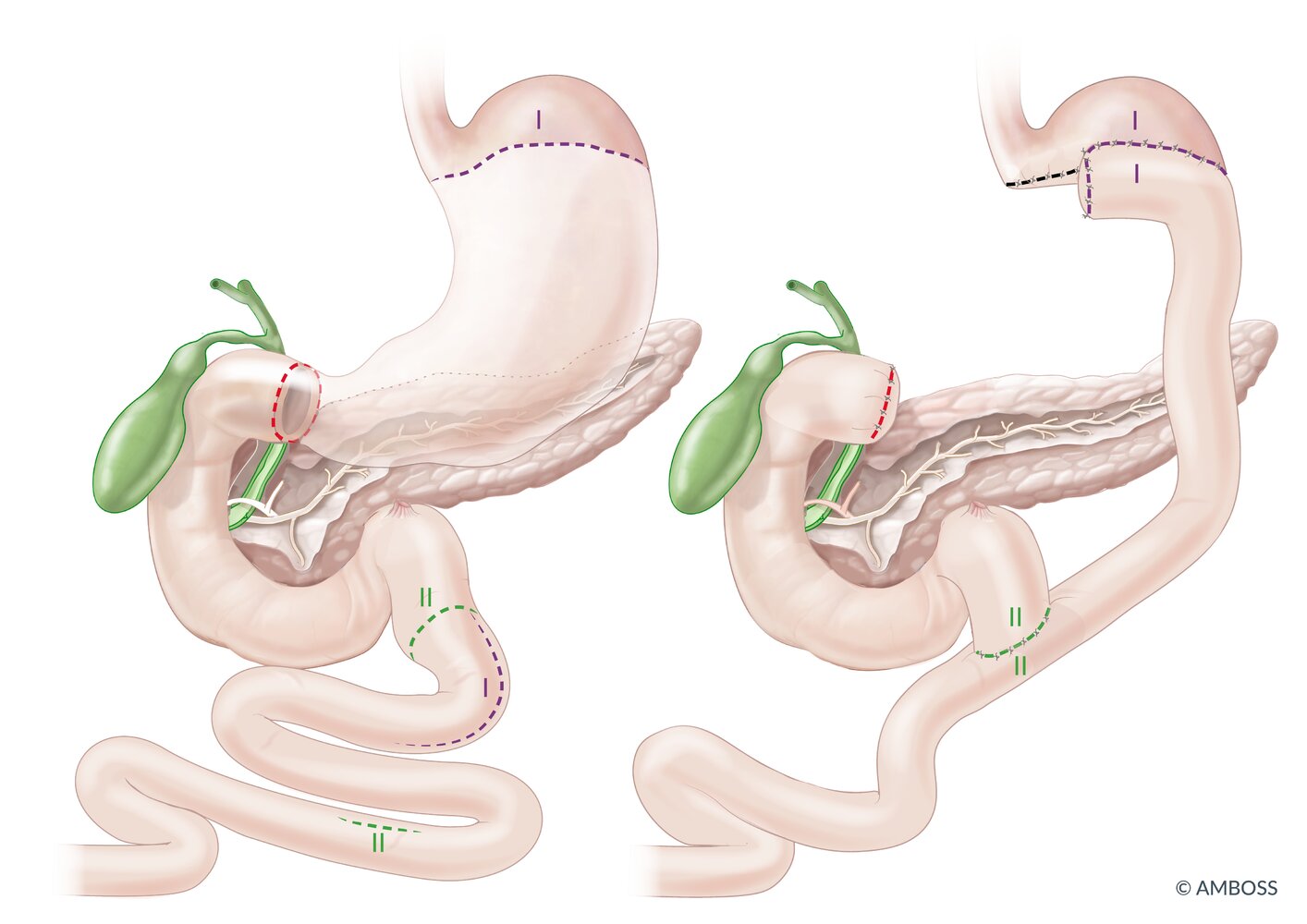 Subtotal gastrectomy (with Roux-en-Y anastomosis)