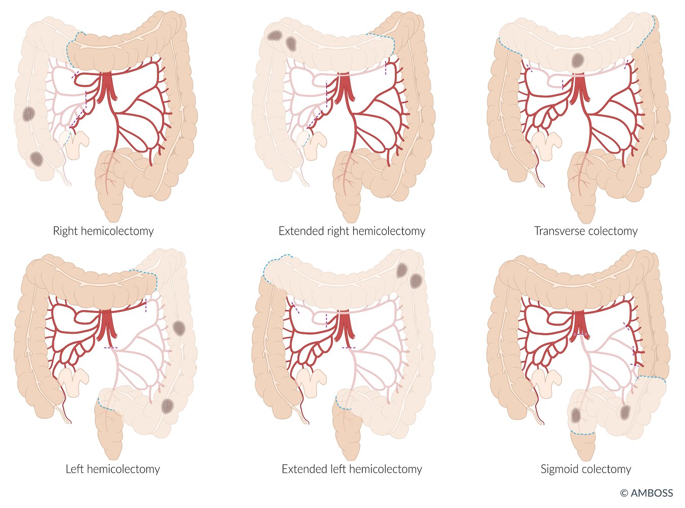 Surgical techniques in colon cancer