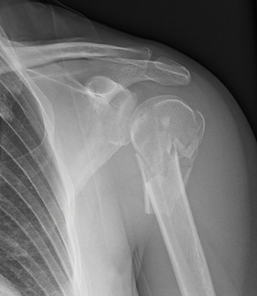 Proximal humerus fracture