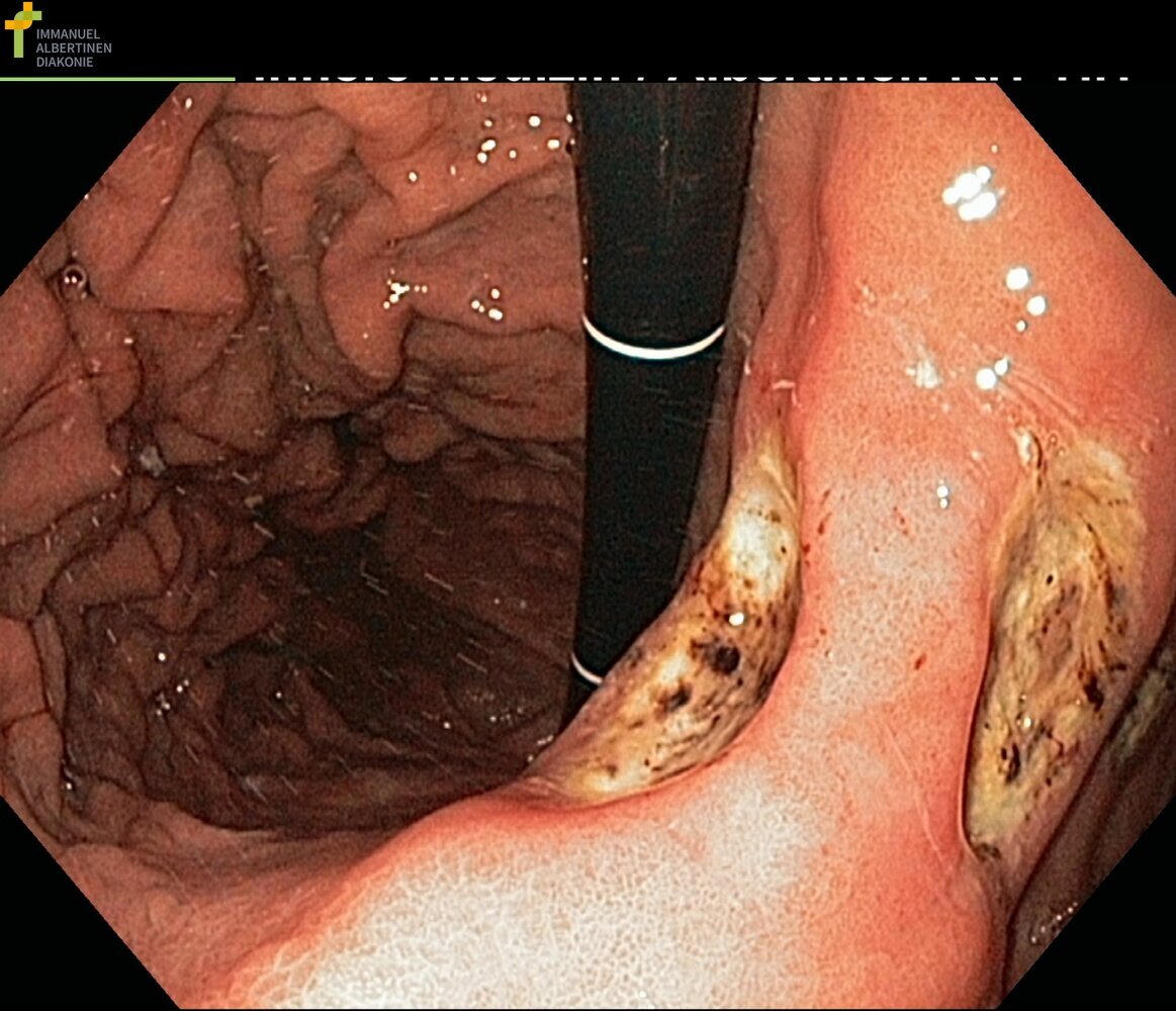 Gastric ulcer: Forrest stage IIc
