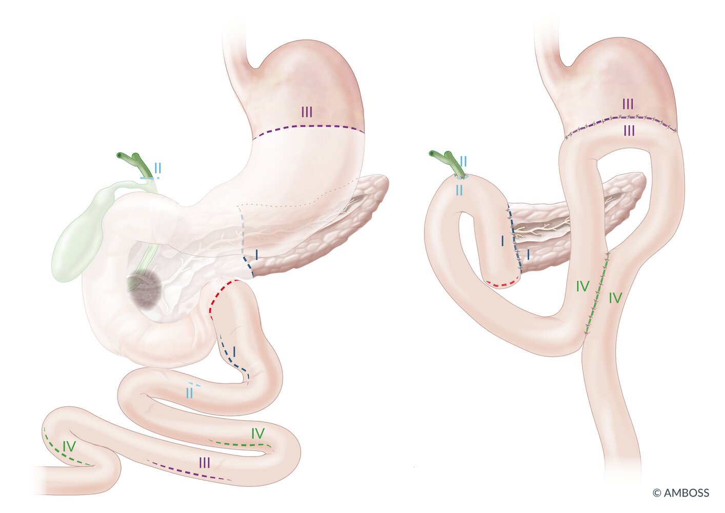 Pancreaticoduodenectomy (Whipple procedure)