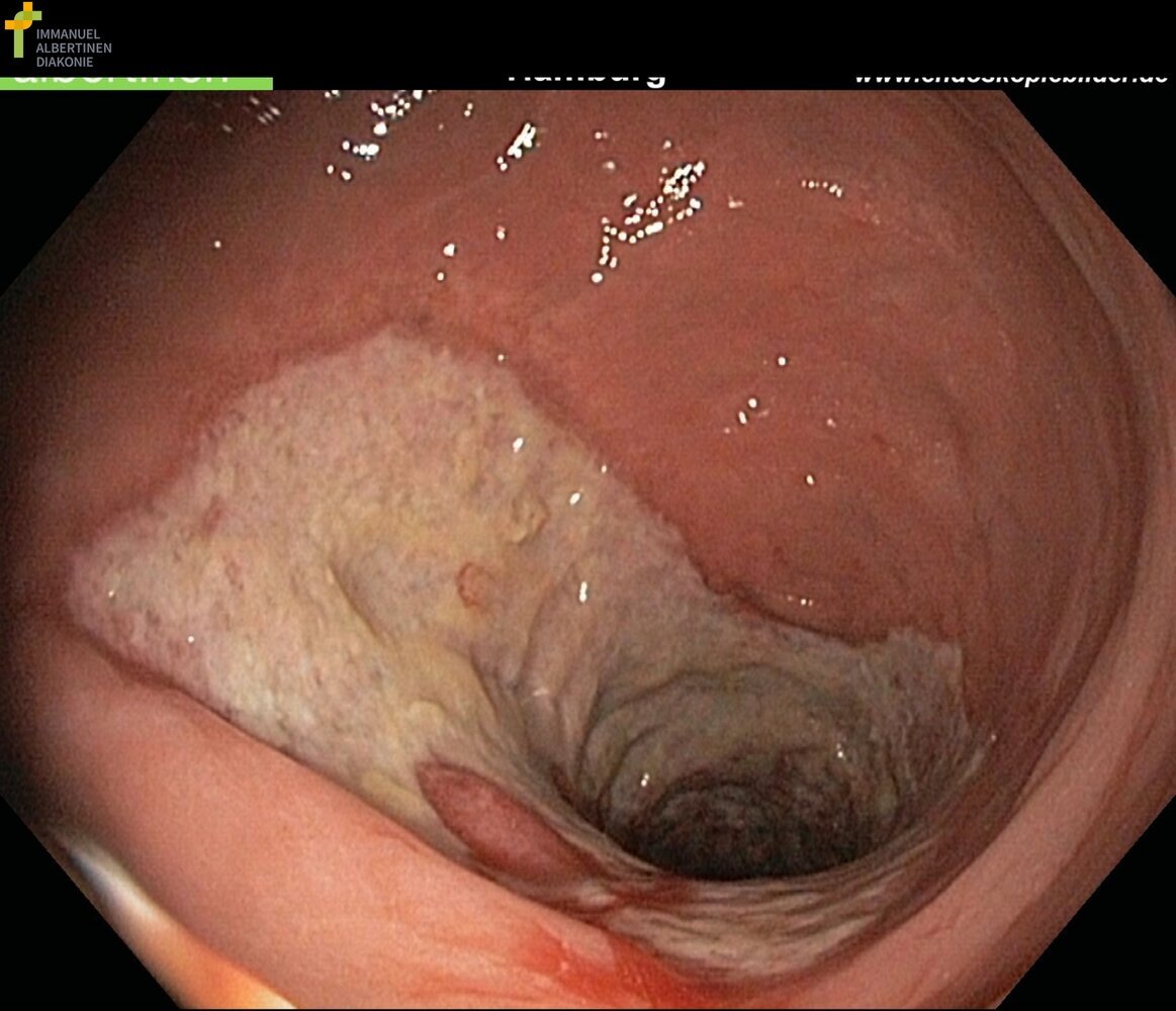 Ischemic colitis