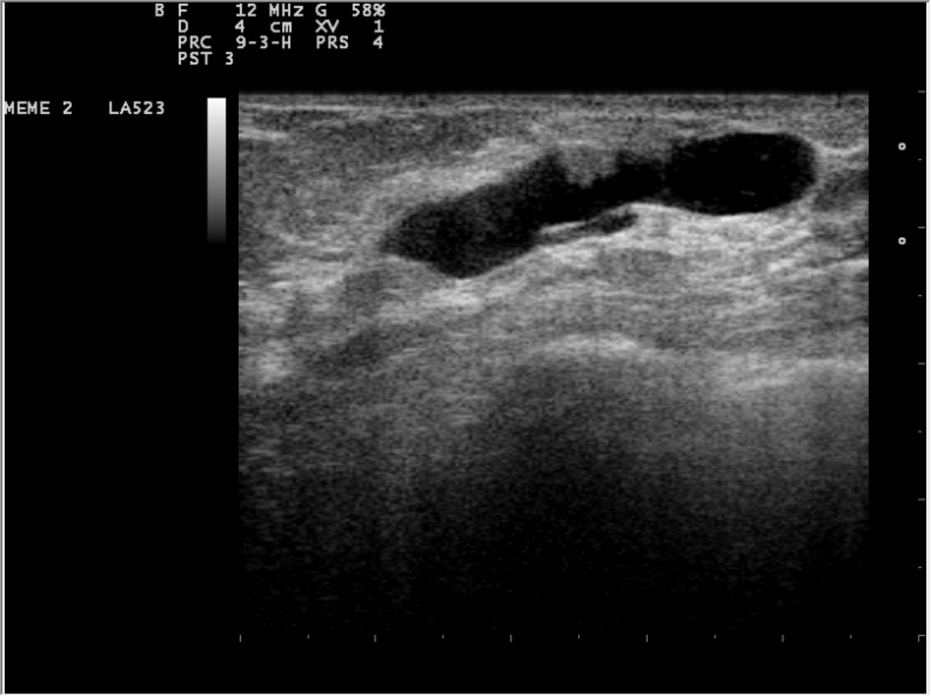 Intraductal breast mass