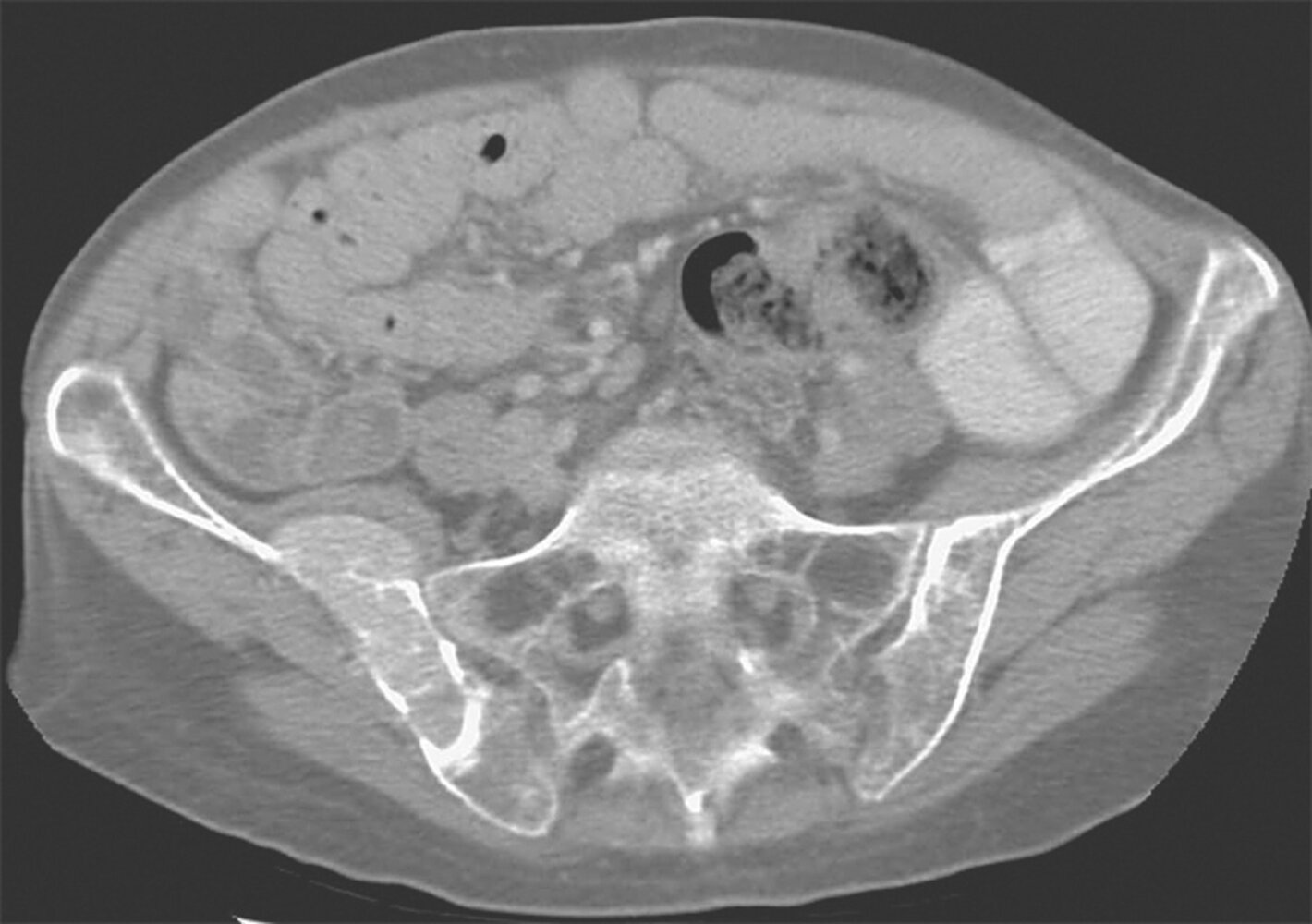 Osseous lesion with extra-osseous extension