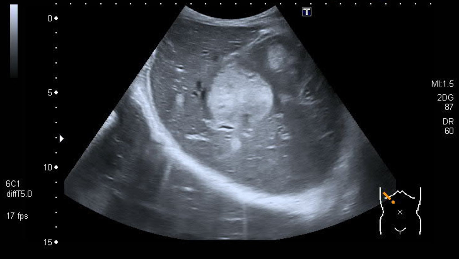 Liver metastases from pancreatic neuroendocrine tumor