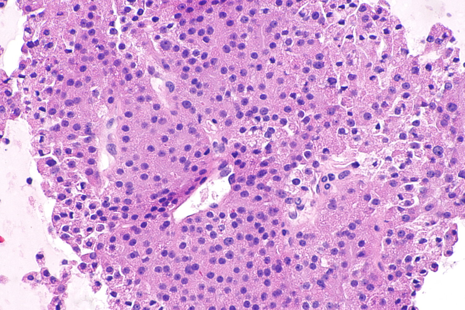 Hurthle cell carcinoma