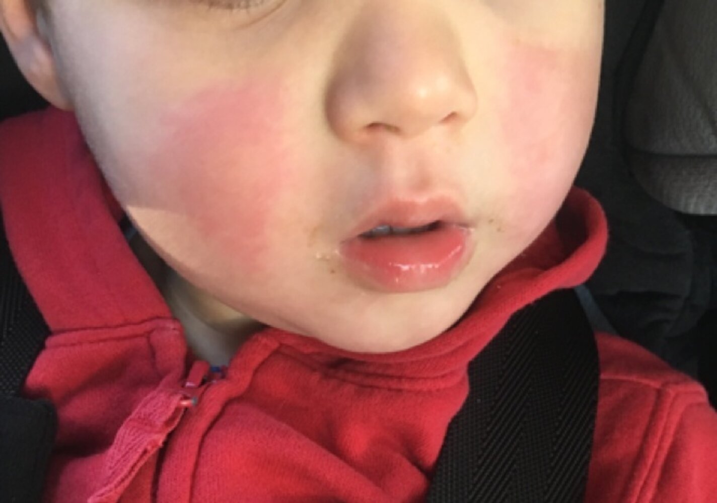 Erythema infectiosum