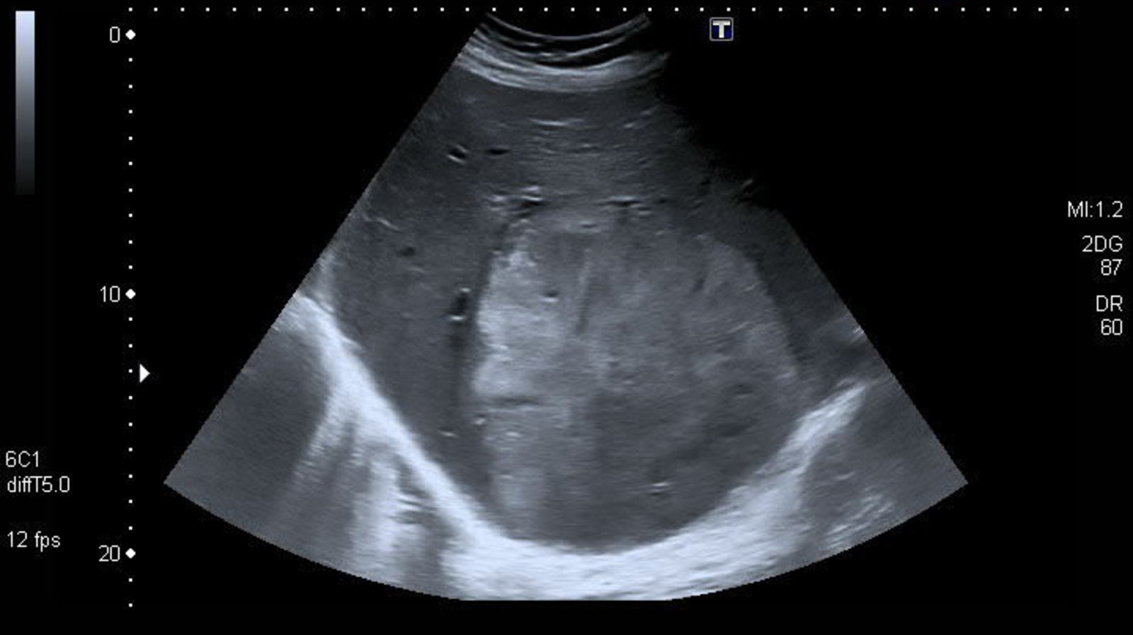 Liver metastasis in renal cell carcinoma