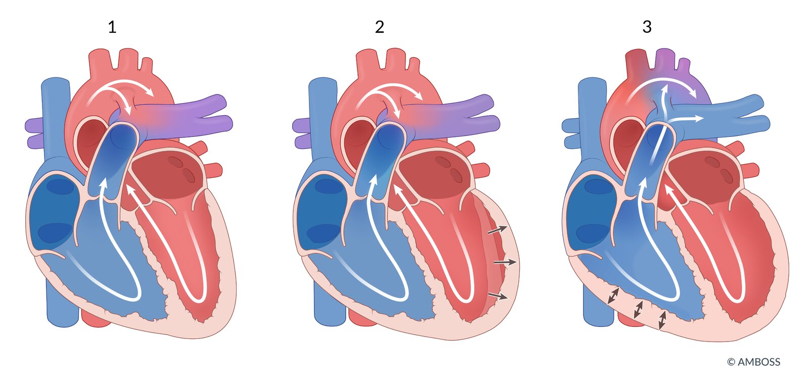 Cardiac hemodynamics in patent ductus arteriosus