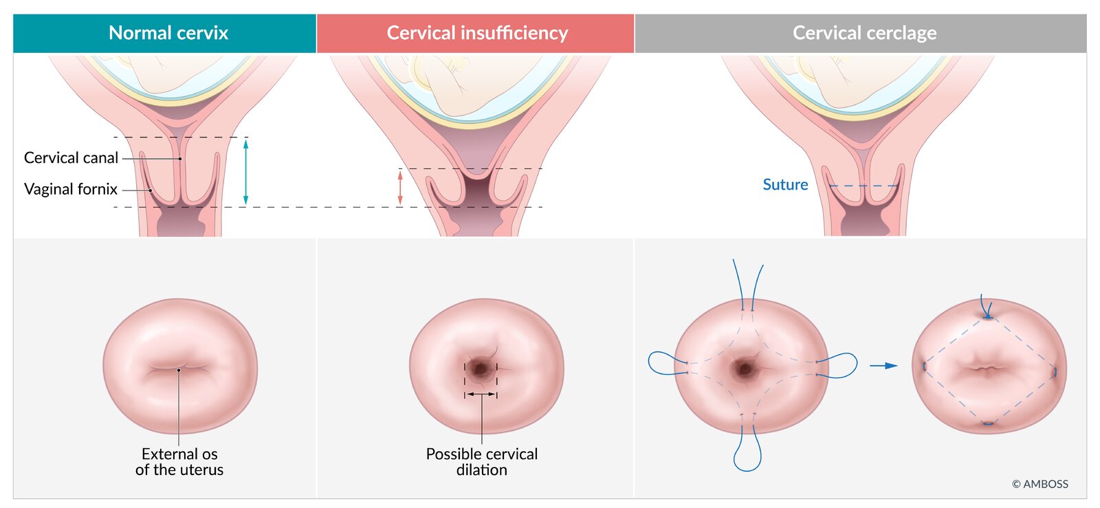Cervical cerclage