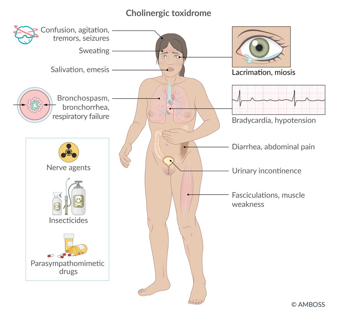 Cholinergic toxidrome