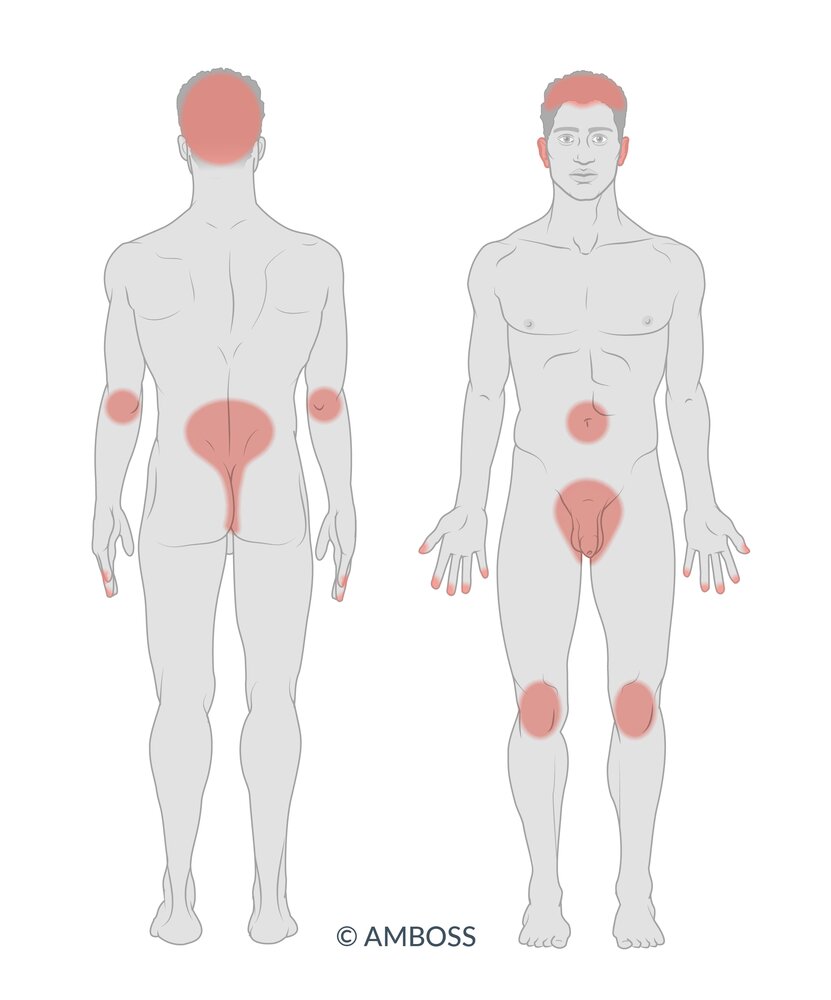 Most common sites of psoriasis