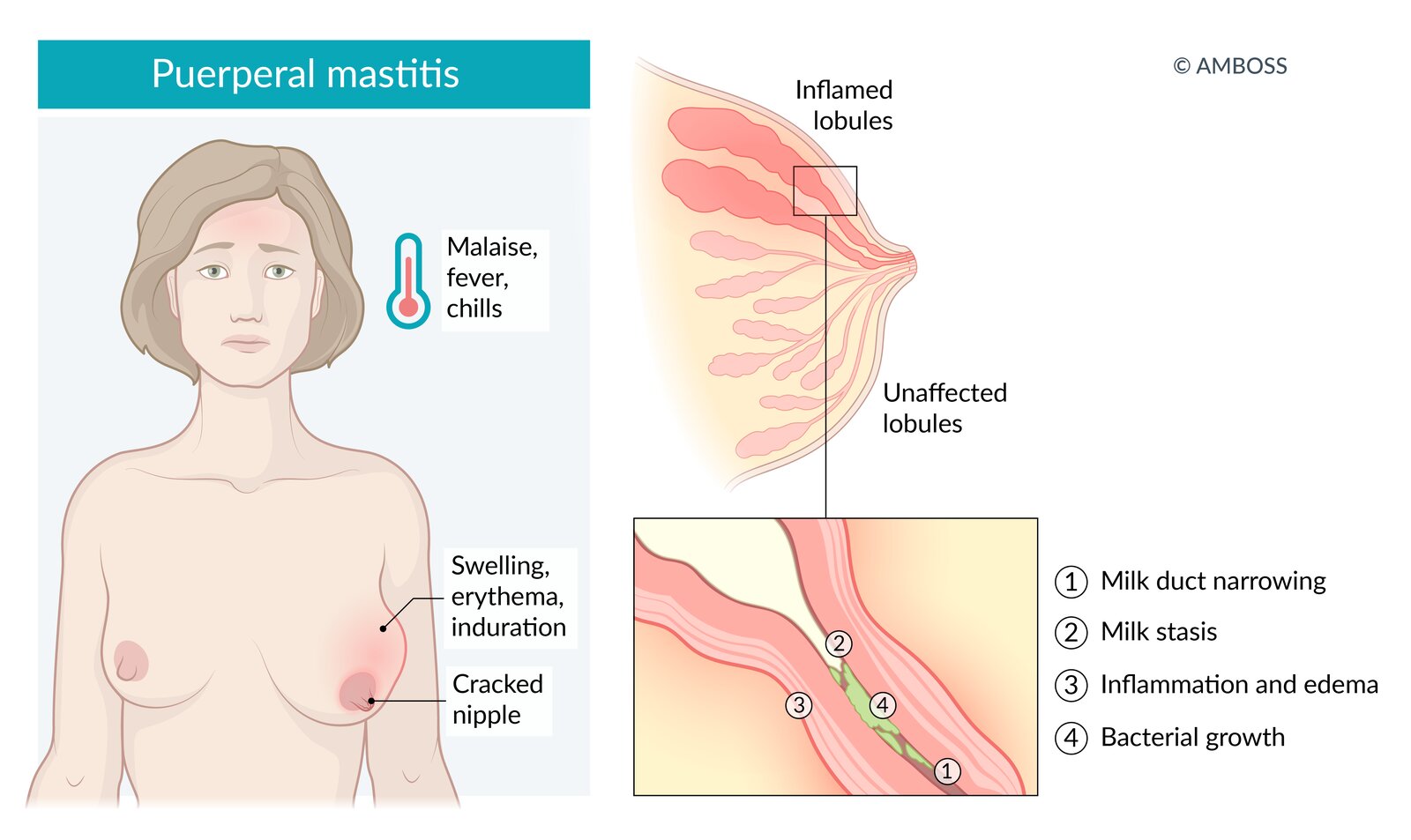 Lactational mastitis