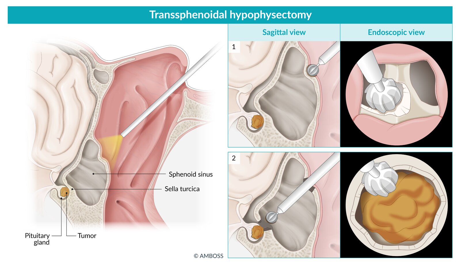 Transsphenoidal hypophysectomy