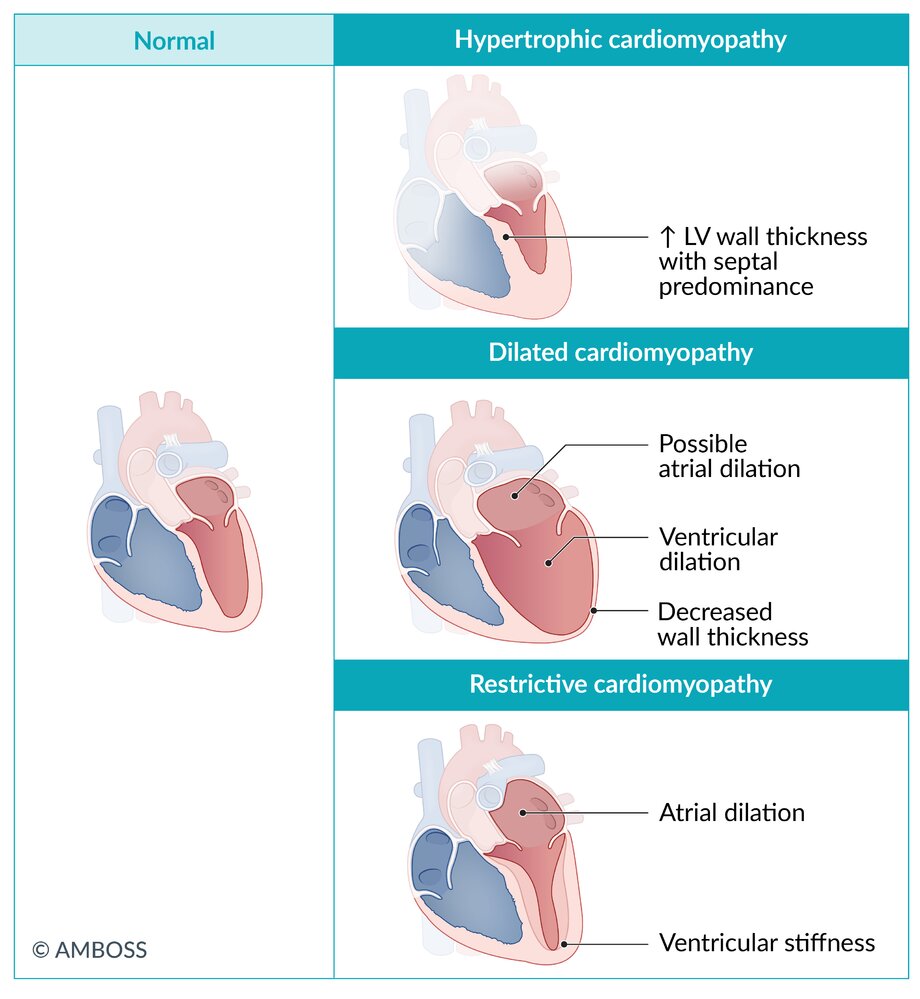 Overview of cardiomyopathies